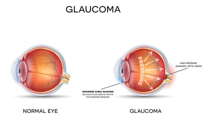 Understanding Glaucoma: Causes, Symptoms, and Treatments