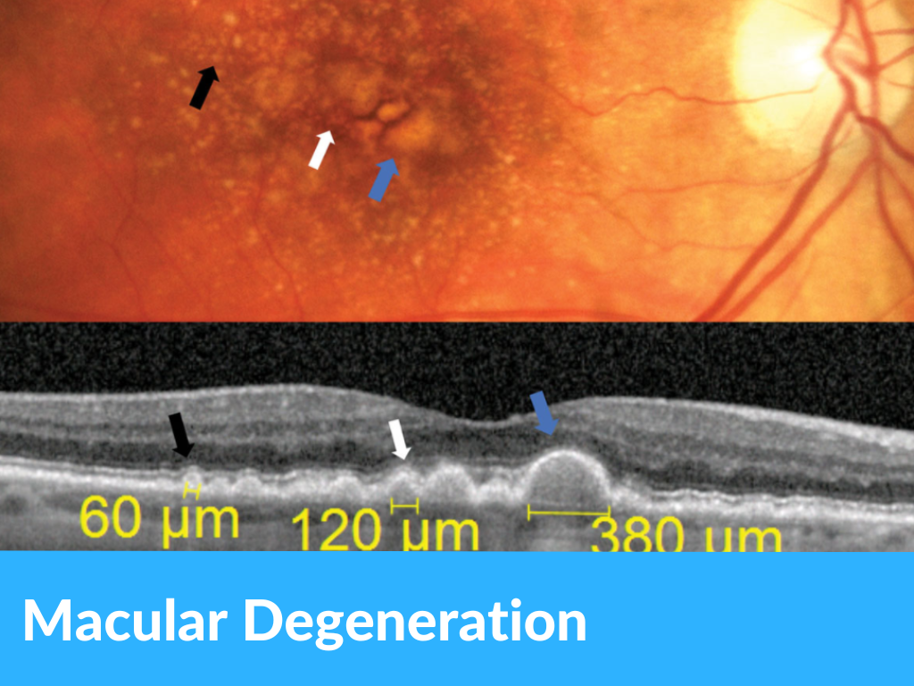 Macular degeneration