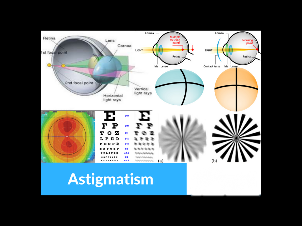 Astigmatism