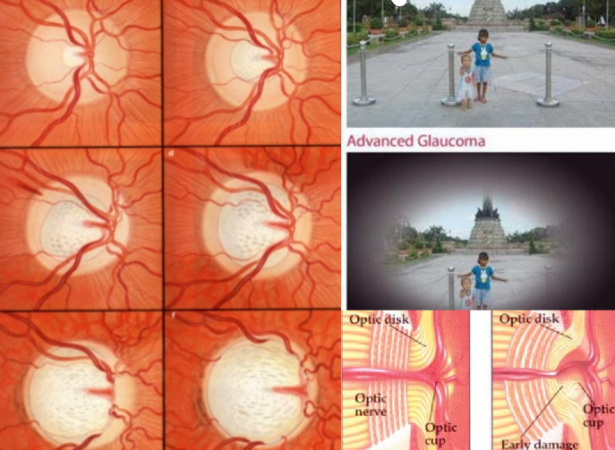 Glaucoma
