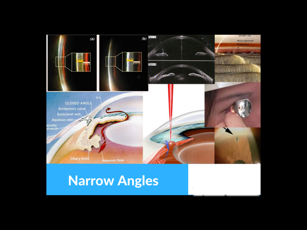 Angle-closure glaucoma