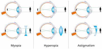 The Differences Between Myopia, Hyperopia, and Astigmatism