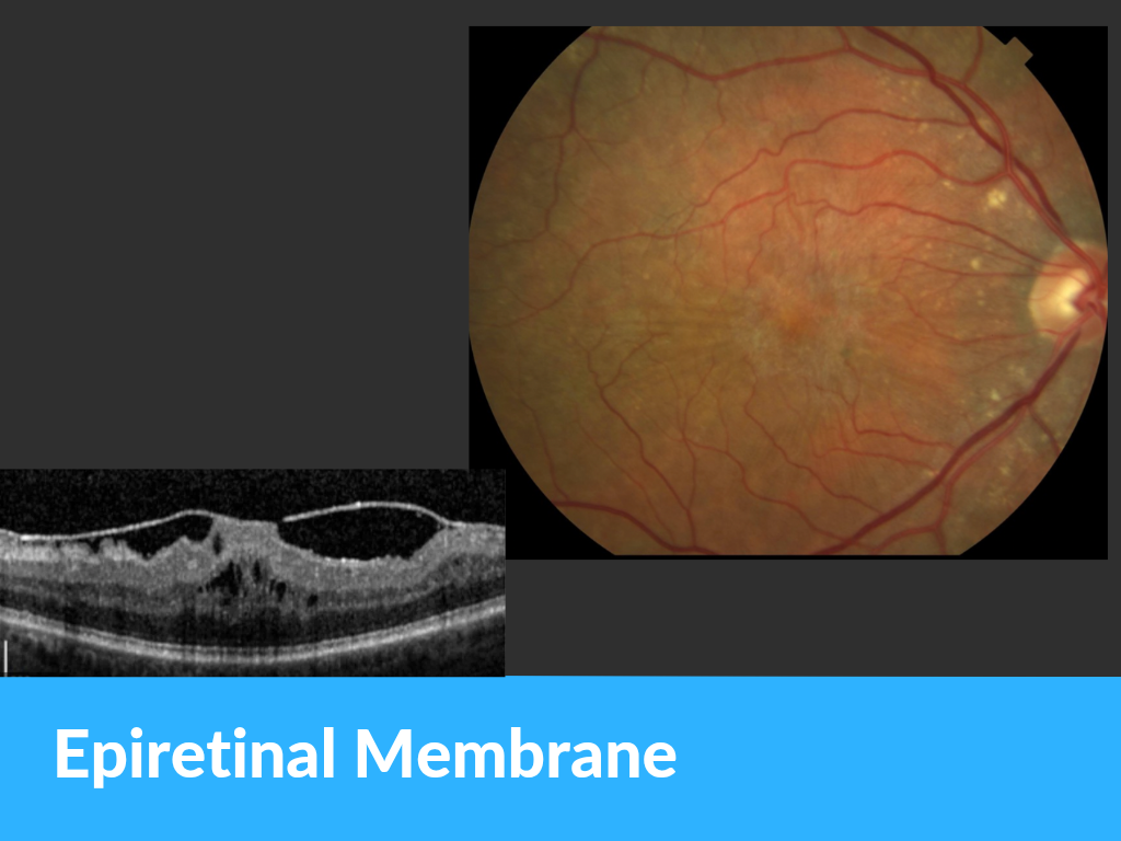 Epiretinal membrane