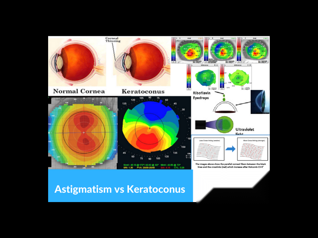Keratoconus