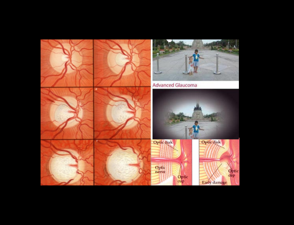 Glaucoma