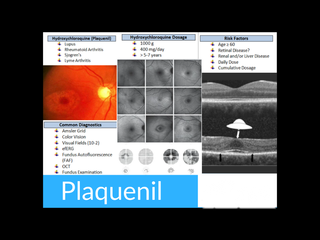 Hydroxychloroquine (Plaquenil) screening