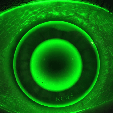 Animated Ortho-K lens fit under fluorescein, myopia control in East Cobb GA